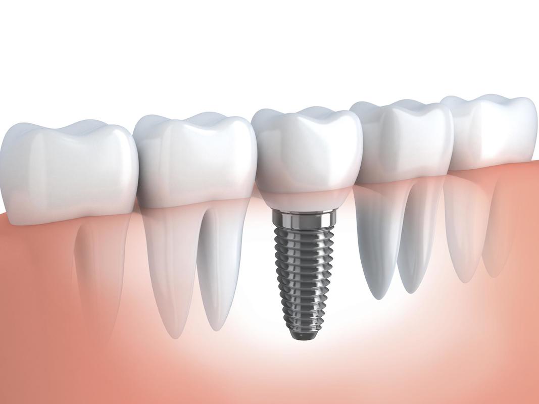 dental implant melbourne