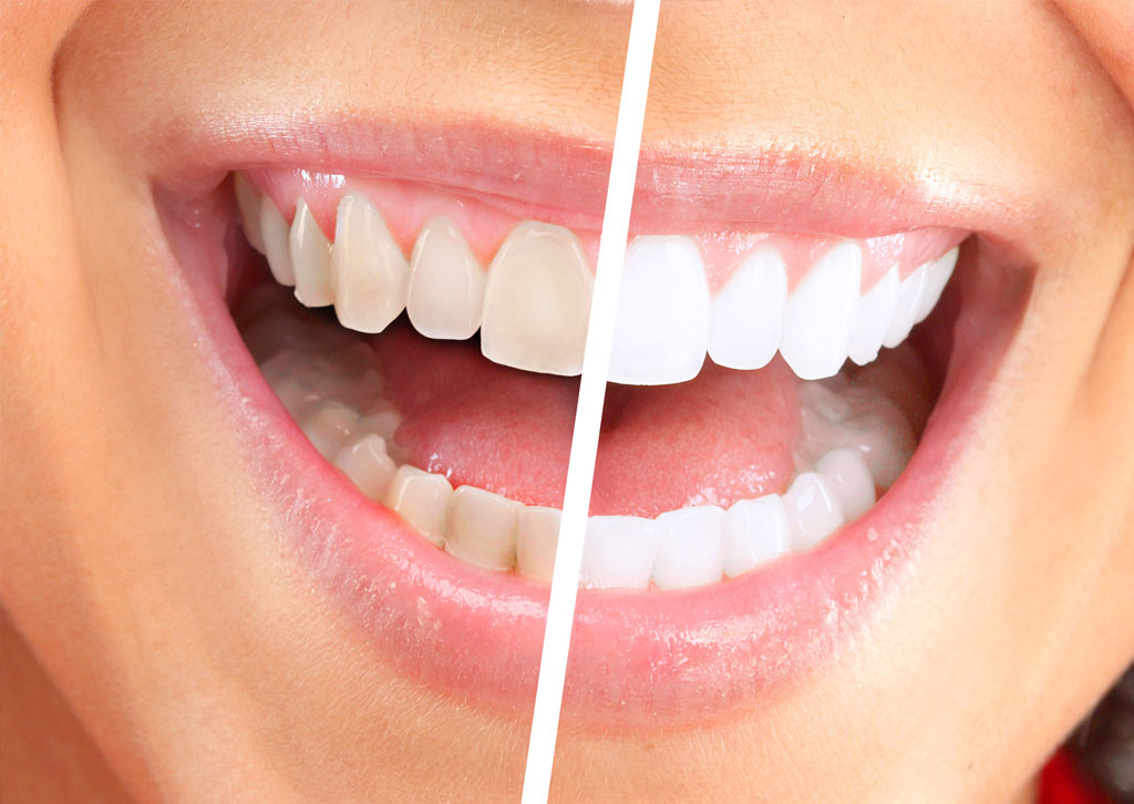 best teeth whitening Melbourne - Captivate Dental